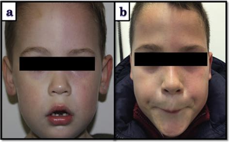 Congenital Harlequin Syndrome As An Isolated Phenomenon A Case Report