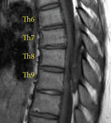 Preoperative Thoracic Mri Heterogeneous Epidural Posterior Mass