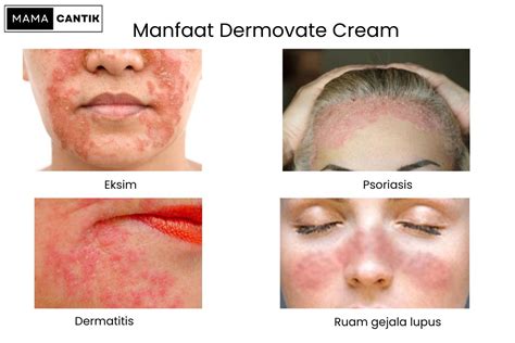 Dermovate Cream Untuk Flek Hitam Apakah Aman Cek Faktanya