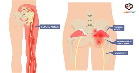 Piriformis Syndrome How To Detect It Plus 10 Strengthening Exercises To Help You Heal