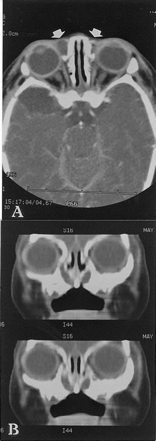 Endoscopic Marsupialization Of Bilateral Lacrimal Sac Mucoceles With