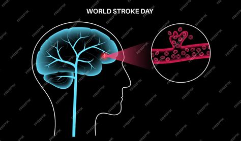 Premium Vector Brain Stroke Hemorrhagic