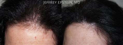 Hair Transplants For Women Fotos Miami Fl Paciente 41680