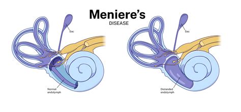 Menieres Disease — The Vertigo Co