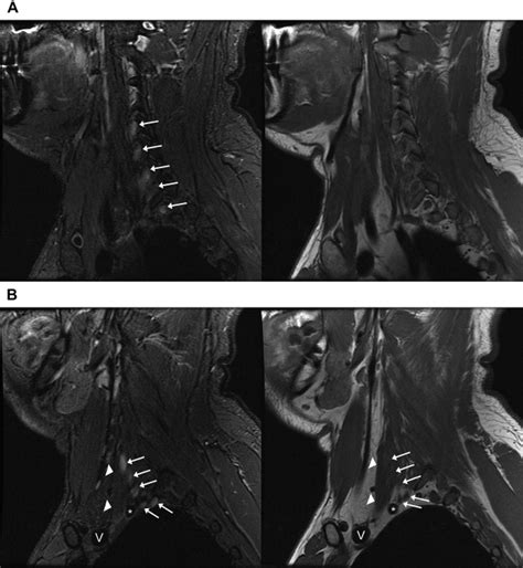 Mri Brachial Plexus Axial T Images The Best Porn Website