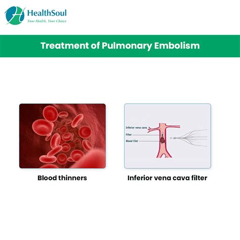 Pulmonary Embolism: Causes, Symptoms and Treatment – Healthsoul