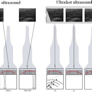 Illustration Of The Conventional Ultrasound Us And Ultrafast