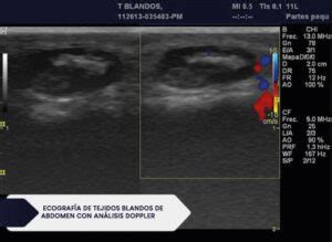 Ecografía de tejidos blandos de abdomen con análisis doppler