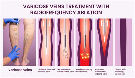 Radiofrequency Ablation