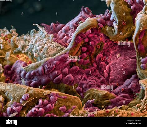 Lung cancer. Coloured scanning electron micrograph (SEM) of tissue from ...