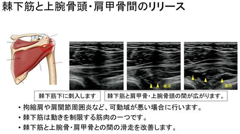 超音波ガイド下注射 上田整形外科内科