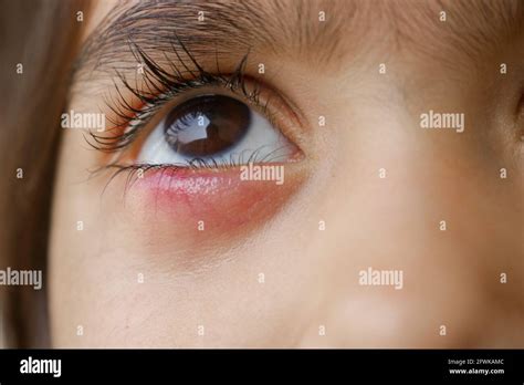 Conjuntivitis virica fotografías e imágenes de alta resolución Alamy