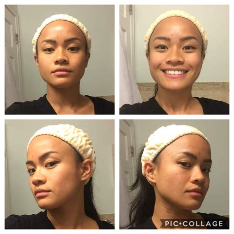 Wisdom Teeth Before And After Face