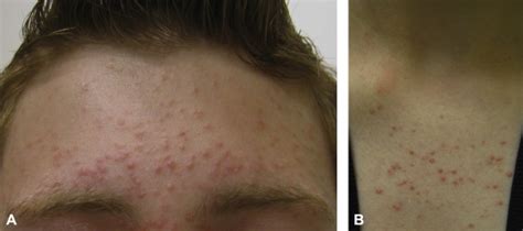 Pityrosporum Folliculitis A Retrospective Review Of 110 Cases