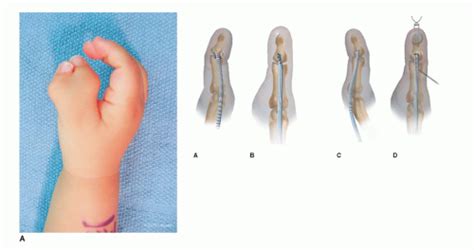 Preaxial Polydactyly Musculoskeletal Key