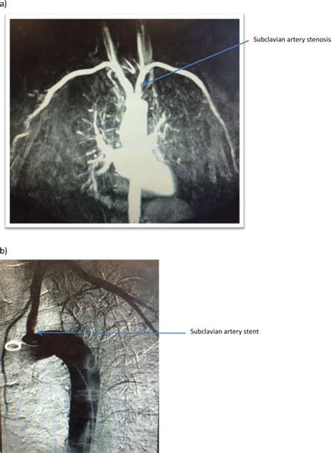 A Pre Op Mra Showing Subclavian Artery Stenosis B Post Stent Download Scientific Diagram