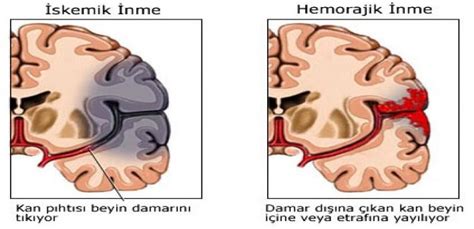 Serebral Damar Hastal Klar Nedir Ve Belirtileri Nelerdir