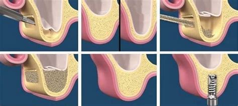 Rialzo Del Seno Mascellare Sinus Lift Clinica Centrodent