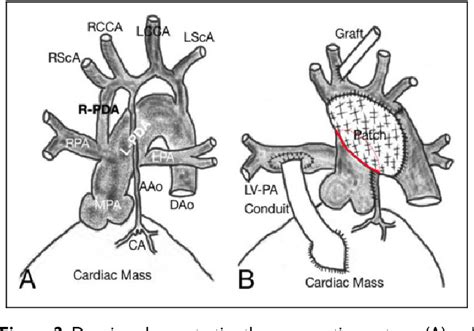 Figure 2 From An Unusual Combination Of Double Inlet Left Ventricle