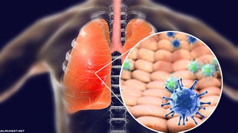 Cos è la polmonite e come possiamo proteggerci Farmacia Cannone