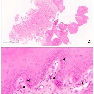 H E On Low Power View A An Incisional Biopsy Of The Tongue With