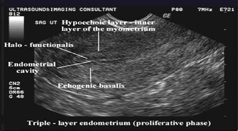 Endometrial Phases Ultrasound