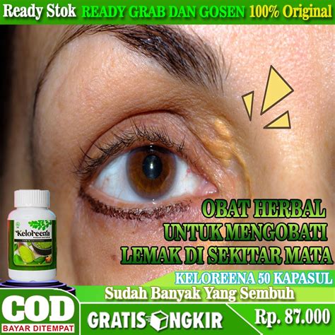 Jual Obat Xanthelasma Obat Gumpalan Lemak Di Kelopak Mata Obat