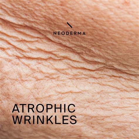 atrophic wrinkles atrophic crinkling rhytids neoderma