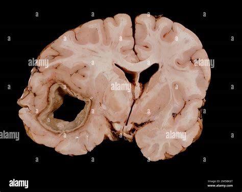 Coronal Section Through A Human Brain At The Caudate And Putamen Level