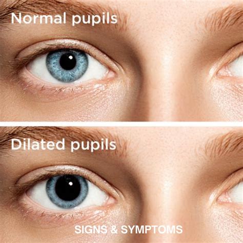 Understanding Dilated Pupils Causes Symptoms And Treatment