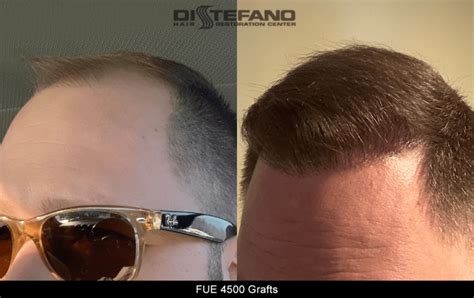 Distefano Hair Restoration And Transplants Ma Ct Ri And Nh