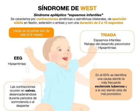 O Que É Sindrome De West - Sahum alerta sobre el síndrome de West: Una rara epilepsia que afecta a ...