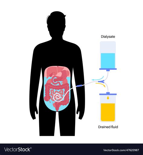 Peritoneal Dialysis Concept Royalty Free Vector Image