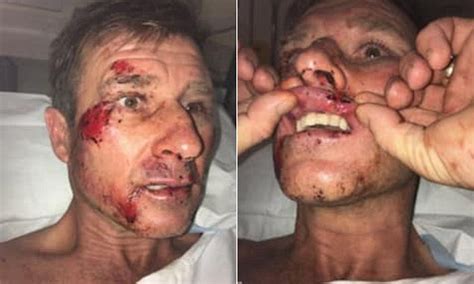 Naked Man Wrestles Would Be Burglars Before Being Dragged Along The Road On A Motorbike Daily