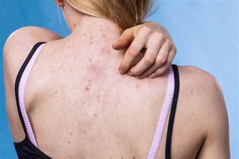 Itchy Acne Types Causes Treatments And More