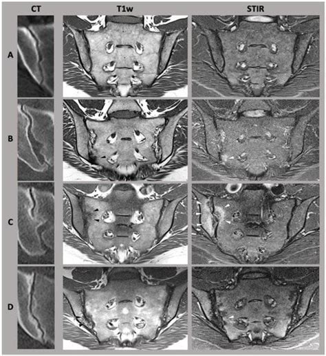 Diagnostics Free Full Text Sex Disparities Of The Sacroiliac Joint Focus On Joint Anatomy