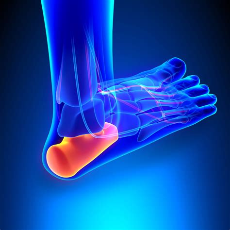 Symptoms and Treatment of Plantar Fasciitis - Chicago Podiatrist