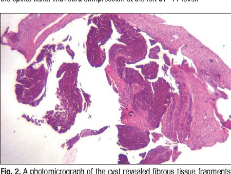 Figure 1 From Acute Myelopathy Caused By A Cervical Synovial Cyst Semantic Scholar