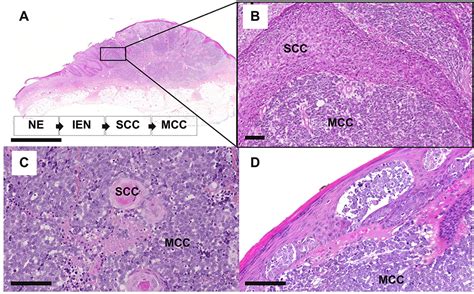 Merkel Cell Carcinoma Histology