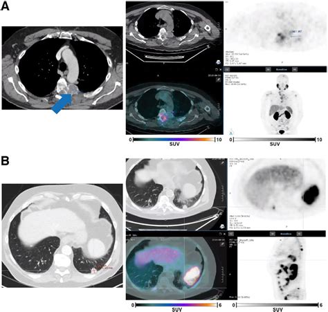 vision substudy  reader agreement  ga psma  petct scan