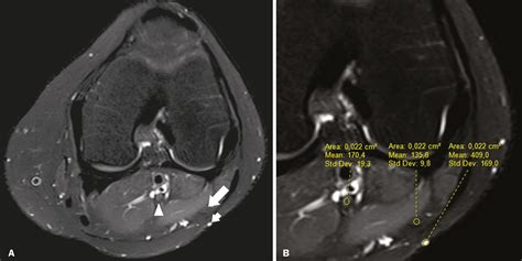 Peroneal Nerve Mri