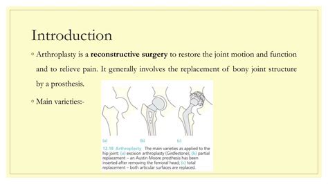 Arthroplasty | PPT