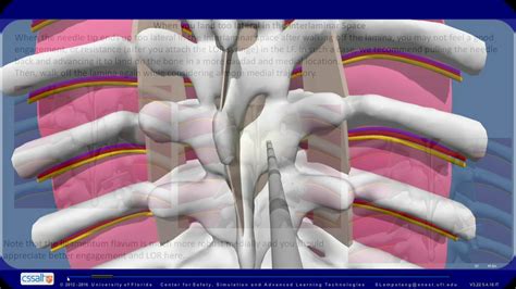 Troubleshooting For Thoracic Epidural Youtube