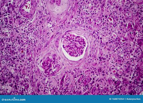 acute glomerulonephritis