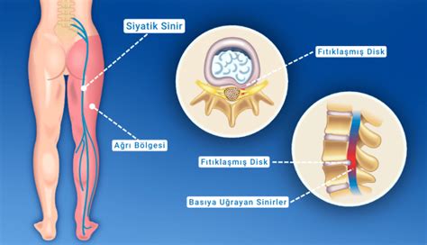 Bacak Ağrısı Nedir Neden Olur ve Neyin Belirtisi Kayhan Turan