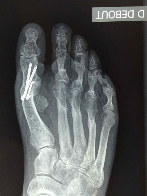 Hallux Rigidus PCNA Pied Cheville Nantes Atlantique