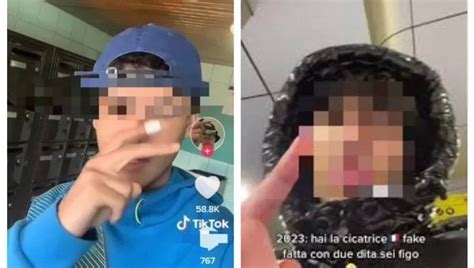 La Sfida Delle Cicatrici Francesi Su Tiktok Ai Ragazzi Serve Una