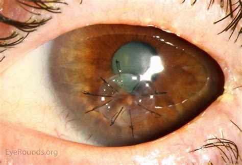 Penetrating Keratoplasty (PK)