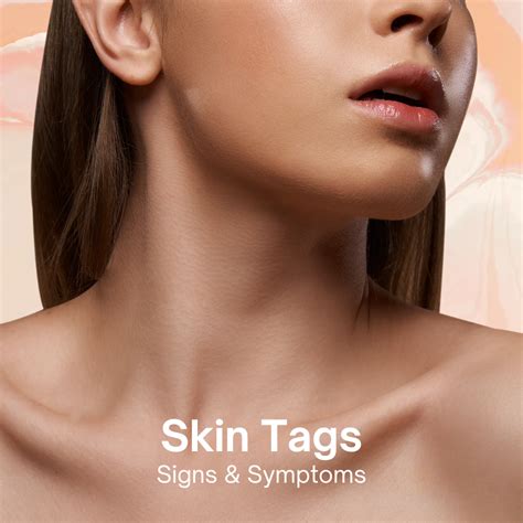 Understanding Skin Tags Causes Treatments And Prevention