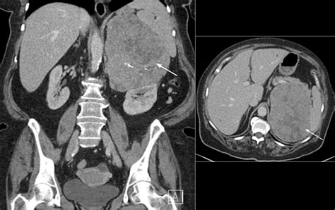 Steroid Profiling In The Diagnosis Of Malignant Adrenal Masses Cases From The Endocrine